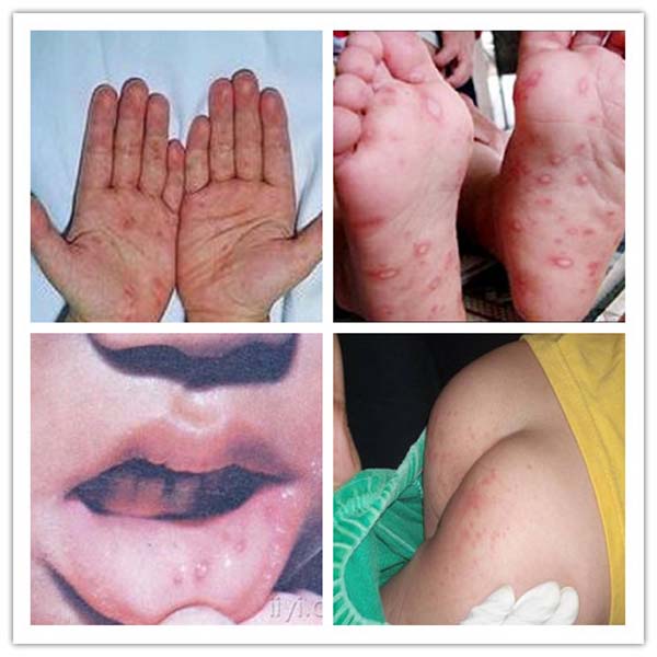 手足口病前期征兆图片图片