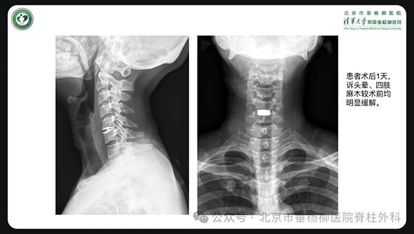 术后复查颈椎生理曲度得到恢复